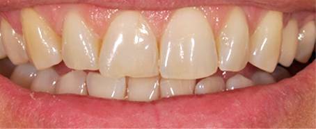 Facings voor case 1