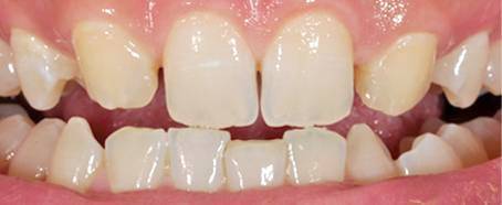 Facings voor case 4