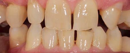 Voor facings TP Middenlaan case 5